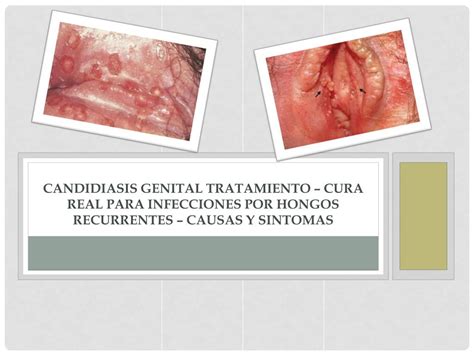 Candidiasis Genitalis